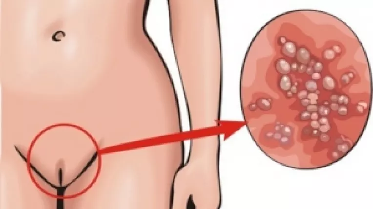 Prezervativul inteligent depisteaza sifilisul, clamydia, herpesul genital si infectia cu papilomavirusuri